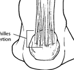 Achilles Tendinitis - The Foot Pod