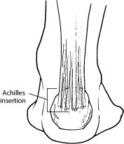 Achilles Tendinitis - The Foot Pod