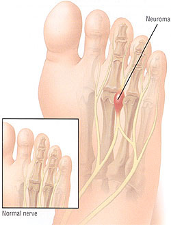 Mortons Neuroma - The Foot Pod