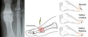 Big Toe Joint Arthritis - The Foot Pod