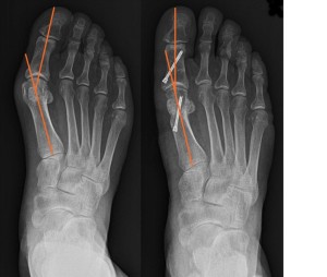 Bunion - The Foot Pod