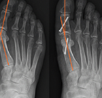 Bunions - The Foot Pod