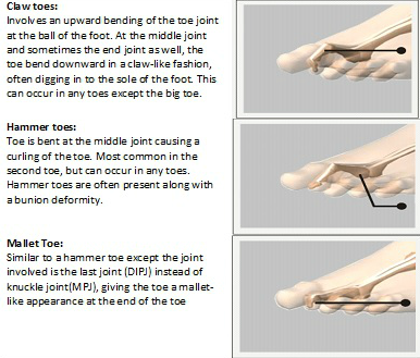 Hammer / Claw Toes - The Foot Pod