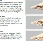 Claw toe, hammer toe - The Foot Pod