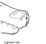 Ingrown Toe Nail - The Foot Pod