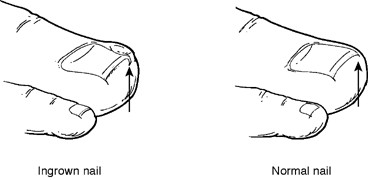 Ingrown Toe Nail - The Foot Pod