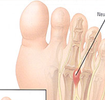 Mortons Neuroma - The Foot Pod