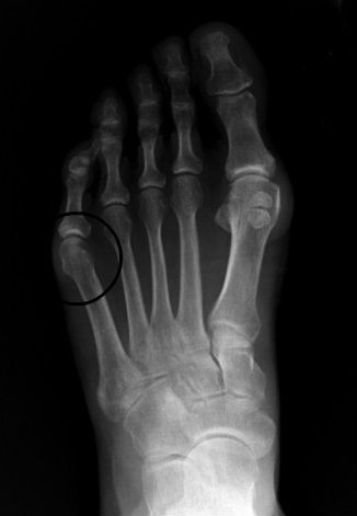 Tailor's Bunion - The Foot Pod